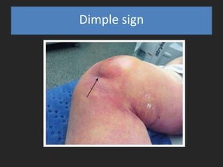 Dimple sign
 