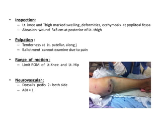 • Inspection:
– Lt. knee and Thigh marked swelling ,deformities, ecchymosis at popliteal fossa
– Abrasion wound 3x3 cm at posterior of Lt. thigh
• Palpation :
– Tenderness at Lt. patellar, along j
– Ballotment cannot examine due to pain
• Range of motion :
– Limit ROM of Lt.Knee and Lt. Hip
• Neurovascular :
– Dorsalis pedis 2+ both side
– ABI = 1
 