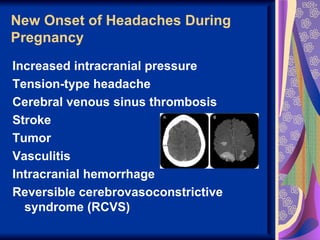 New Onset of Headaches During
Pregnancy
Increased intracranial pressure
Tension-type headache
Cerebral venous sinus thrombosis
Stroke
Tumor
Vasculitis
Intracranial hemorrhage
Reversible cerebrovasoconstrictive
  syndrome (RCVS)
 