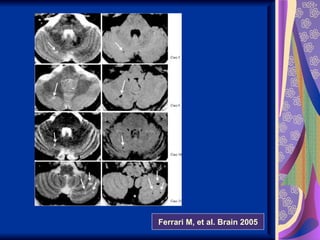 Ferrari M, et al. Brain 2005
 