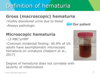 © 2016 Virginia Mason Medical Center
Definition of hematuria
Gross (macroscopic) hematuria
-Visibly discolored urine due to blood
-Always pathologic
Microscopic hematuria
- ≥3 RBC’s/HPF
-Common incidental finding: 40.9% of US
adults have asymptomatic microscopic
hematuria on urinalysis (Halpern et al.,
2017)
Degree of hematuria does not correlate with
severity of inflammation
3
Our patient
 