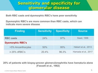 © 2016 Virginia Mason Medical Center
Sensitivity and specificity for
glomerular disease
Finding Sensitivity Specificity Source
RBC casts 24% 97% Saad, 1996
Dysmorphic RBC’s
>5% Ancanthocytes 50% 95% Hebert et al., 2013
≥ 25% dRBC’s 20.4% 96.3% Hamada et al., 2017
5
20% of patients with biopsy-proven glomerulonephritis have hematuria alone
(Fassett et al., 1982)
Both RBC casts and dysmorphic RBC’s have poor sensitivity
Dysmorphic RBC’s are more common than RBC casts, which can
indicate more severe disease
 