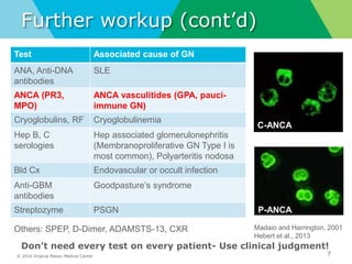 © 2016 Virginia Mason Medical Center
Further workup (cont’d)
7
Test Associated cause of GN
ANA, Anti-DNA
antibodies
SLE
ANCA (PR3,
MPO)
ANCA vasculitides (GPA, pauci-
immune GN)
Cryoglobulins, RF Cryoglobulinemia
Hep B, C
serologies
Hep associated glomerulonephritis
(Membranoproliferative GN Type I is
most common), Polyarteritis nodosa
Bld Cx Endovascular or occult infection
Anti-GBM
antibodies
Goodpasture’s syndrome
Streptozyme PSGN
Don’t need every test on every patient- Use clinical judgment!
C-ANCA
P-ANCA
Madaio and Harrington, 2001
Hebert et al., 2013
Others: SPEP, D-Dimer, ADAMSTS-13, CXR
 