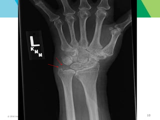 © 2016 Virginia Mason Medical Center 10
right lung nodules and infiltrates
 