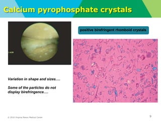 © 2016 Virginia Mason Medical Center
Calcium pyrophosphate crystals
vv
9
positive birefringent rhomboid crystals
Variation in shape and sizes….
Some of the particles do not
display birefringence….
 