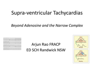Supra-ventricular Tachycardias
Beyond Adenosine and the Narrow Complex

Arjun Rao FRACP
ED SCH Randwick NSW

 