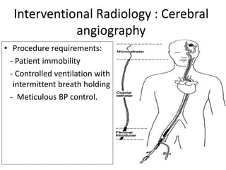 Interventional Radiology : Cerebral
angiography
• Procedure requirements:
- Patient immobility
- Controlled ventilation with
intermittent breath holding
- Meticulous BP control.
 