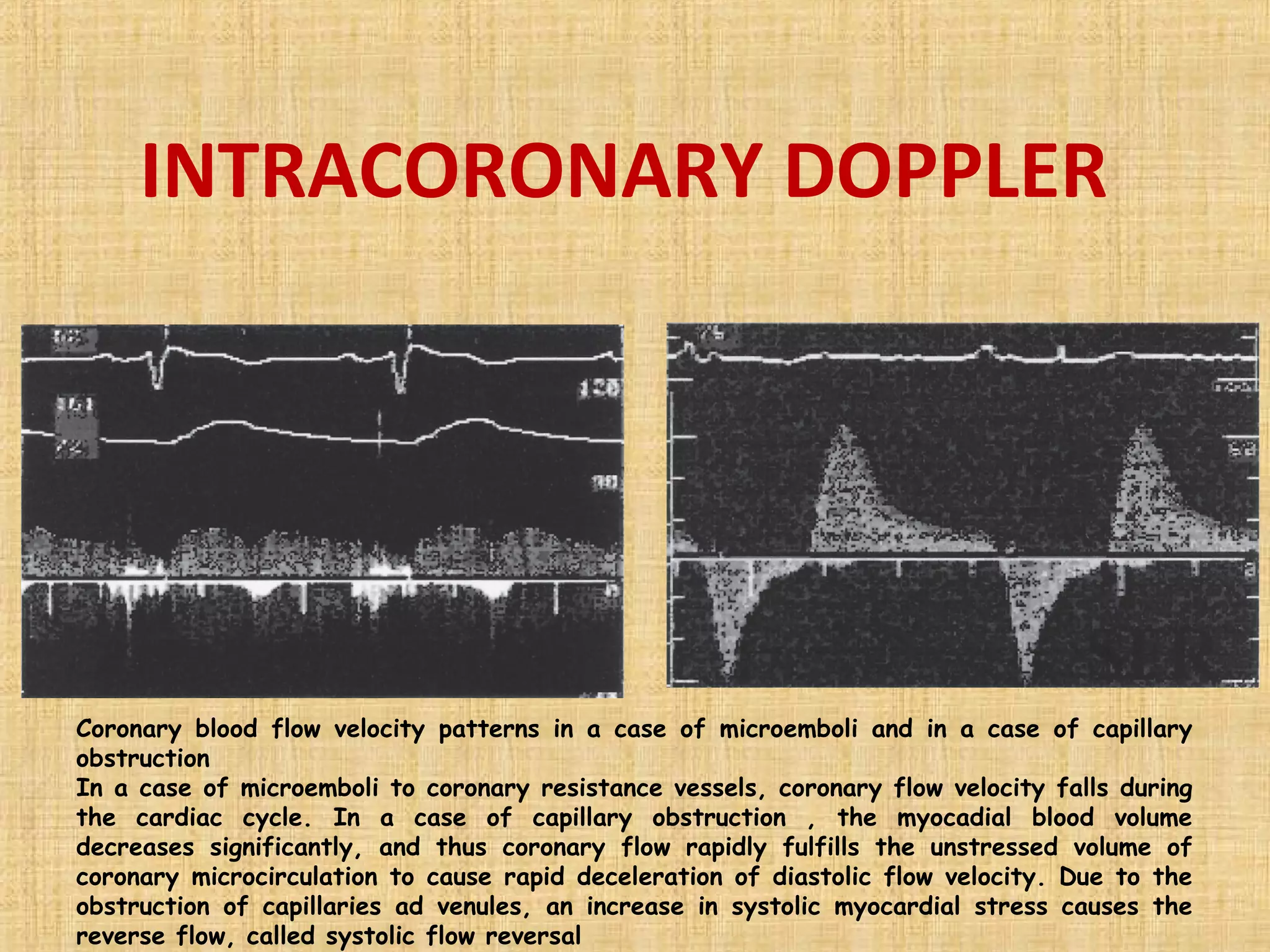 No reflow and slow flow phenomenon during pci | PPT