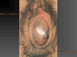 Normal and abnormal genital tract 