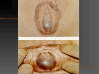 Normal and abnormal genital tract 