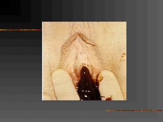 Normal and abnormal genital tract 