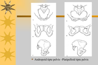 <ul><li>Andropoid tipte pelvis –Platipelloid tipte pelvis </li></ul>