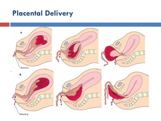 Placental Delivery
 