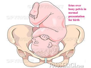 fetus over
bony pelvis in
normal
presentation
for birth
 