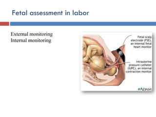 Fetal assessment in labor
External monitoring
Internal monitoring
 