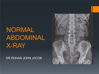 NORMAL
ABDOMINAL
X-RAY
DR.ROHAN JOHN JACOB
 