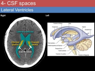 Normal & abnormal radiology of brain part ii | PPTX