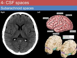 Normal & abnormal radiology of brain part ii | PPTX