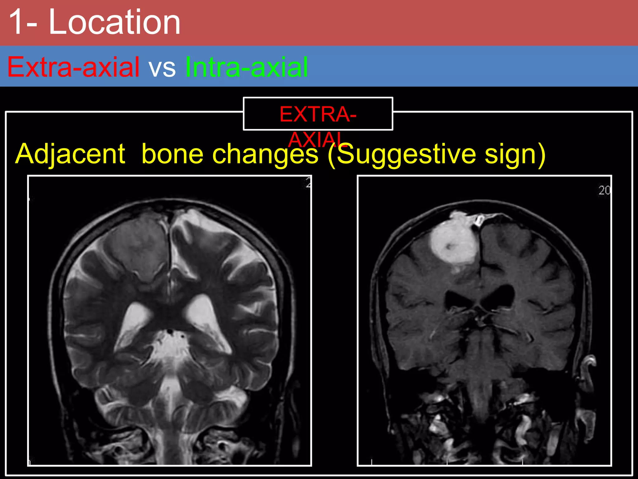 1- Location
Extra-axial vs Intra-axial
EXTRA-
AXIAL
Adjacent bone changes (Suggestive sign)
 