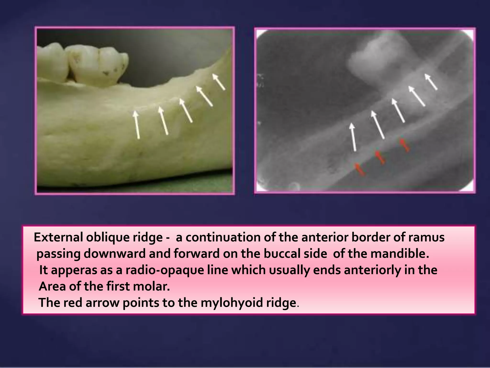 Oblique Ridge Radiography Normal Radiographic Anatomical Landmarks | PPTX