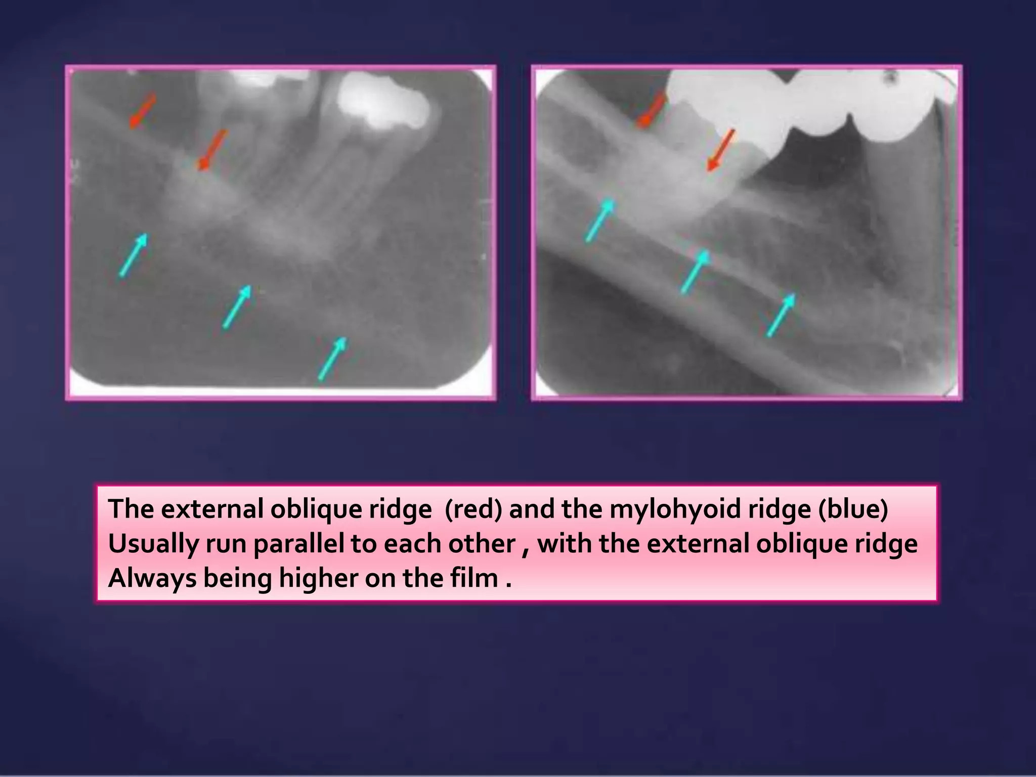 Normal Radiographic Anatomical Landmarks | PPTX