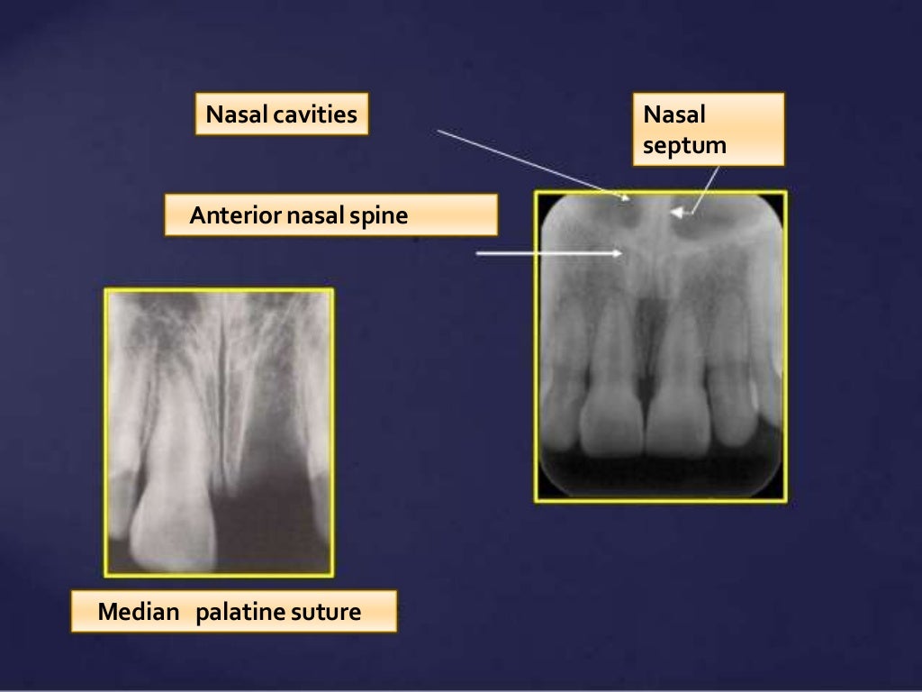 Normal Radiographic Anatomical Landmarks