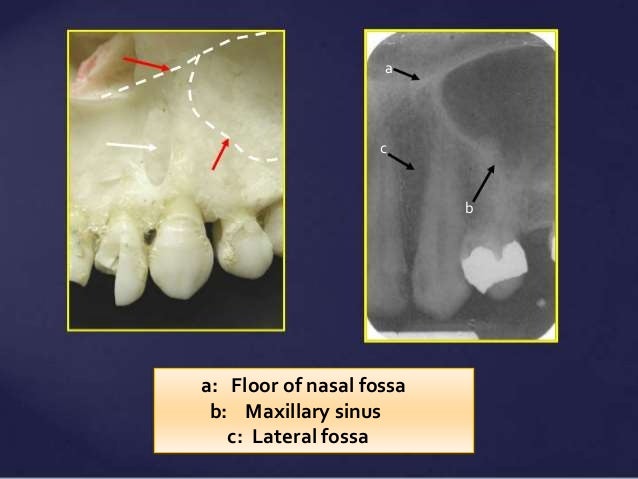 Nasal Fossa Radiograph