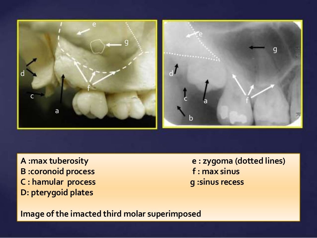 Normal Radiographic Anatomical Landmarks