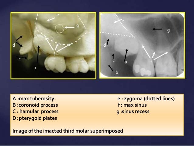 Normal Radiographic Anatomical Landmarks
