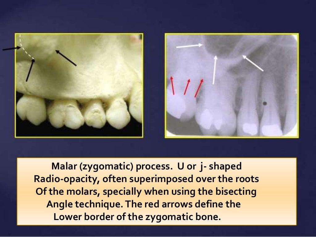 Normal Radiographic Anatomical Landmarks