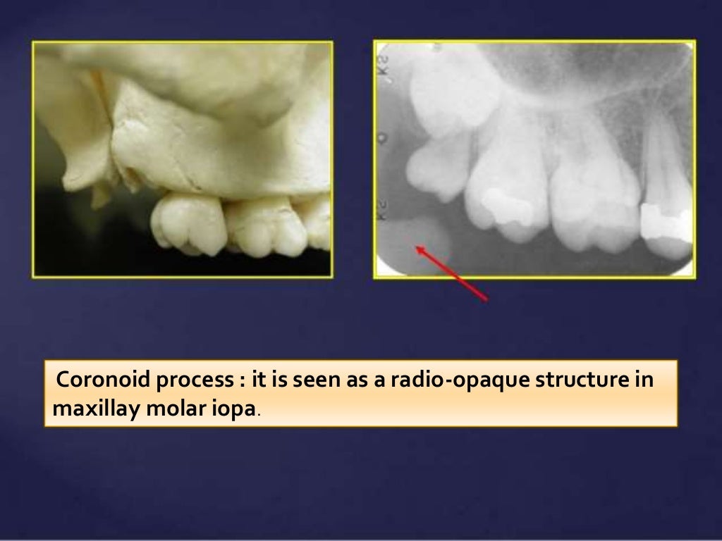 Normal Radiographic Anatomical Landmarks