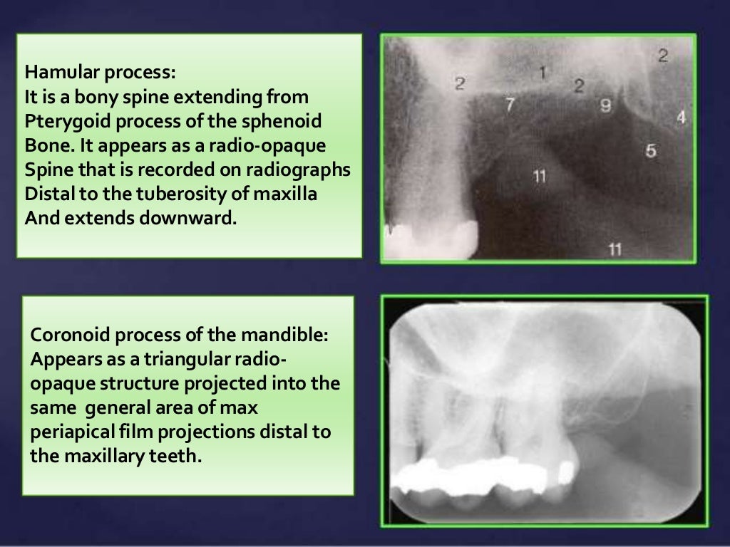 Normal Radiographic Anatomical Landmarks