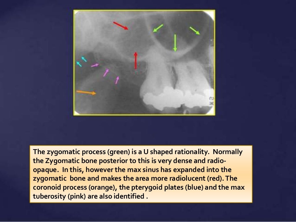 Normal Radiographic Anatomical Landmarks