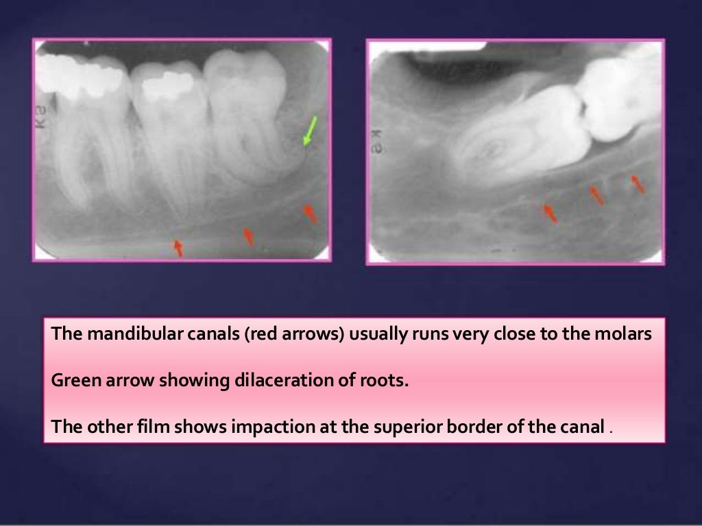 Normal Radiographic Anatomical Landmarks