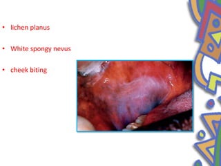 • lichen planus
• White spongy nevus
• cheek biting
 
