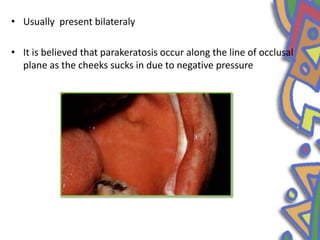 • Usually present bilateraly
• It is believed that parakeratosis occur along the line of occlusal
plane as the cheeks sucks in due to negative pressure
 