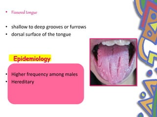 • Fissured tongue
• shallow to deep grooves or furrows
• dorsal surface of the tongue
Epidemiology
• Higher frequency among males
• Hereditary
 