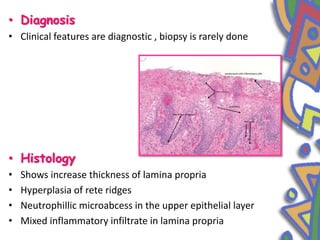• Diagnosis
• Clinical features are diagnostic , biopsy is rarely done
• Histology
• Shows increase thickness of lamina propria
• Hyperplasia of rete ridges
• Neutrophillic microabcess in the upper epithelial layer
• Mixed inflammatory infiltrate in lamina propria
 