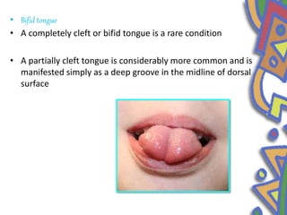 • Bifid tongue
• A completely cleft or bifid tongue is a rare condition
• A partially cleft tongue is considerably more common and is
manifested simply as a deep groove in the midline of dorsal
surface
 
