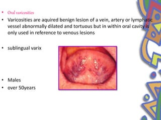 • Oral varicosities
• Varicosities are aquired benign lesion of a vein, artery or lymphatic
vessel abnormally dilated and tortuous but in within oral cavity is
only used in reference to venous lesions
• sublingual varix
• Males
• over 50years
 