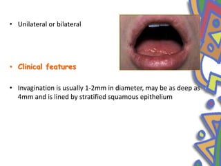 • Unilateral or bilateral
• Clinical features
• Invagination is usually 1-2mm in diameter, may be as deep as
4mm and is lined by stratified squamous epithelium
 