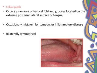 • Folliate papilla
• Occurs as an area of vertical fold and grooves located on the
extreme posterior lateral surface of tongue
• Occasionaly mistaken for tumours or inflammatory disease
• Bilaterally symmetrical
 
