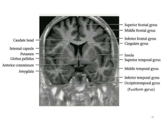 Normal anatomy of brain on CT and MRI