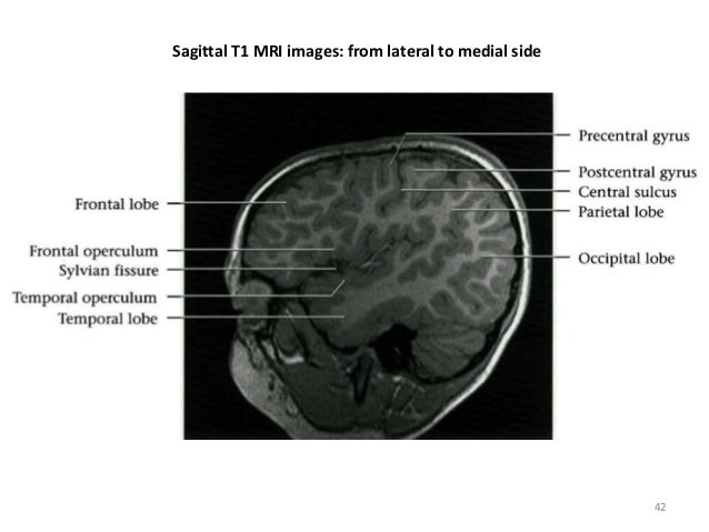 hippocampus anatomy sulcus coronal t1 mri hippocampus anatomy sulcus coronal t1 mri