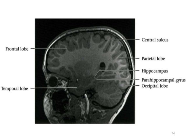 Normal anatomy of brain on CT and MRI
