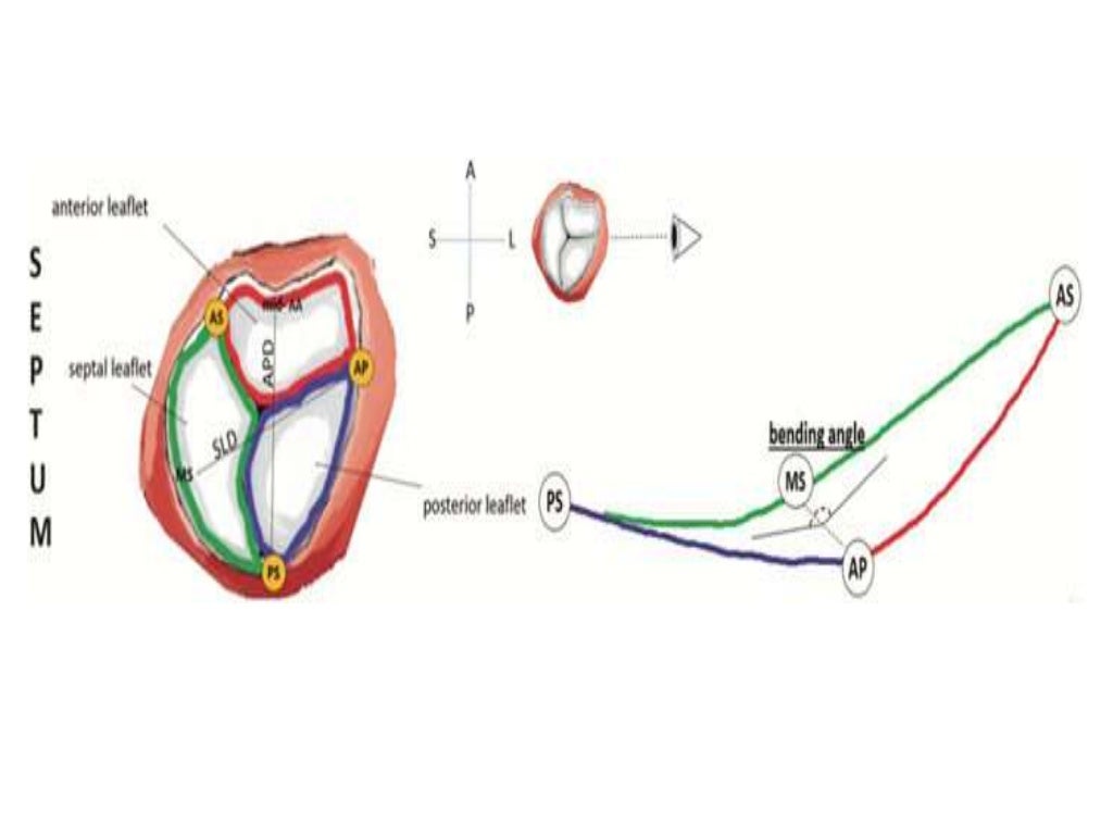 Normal anatomy of tricuspid valve