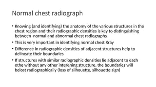 Comprehensive Guide to Normal and Abnormal Chest Radiographs in ...