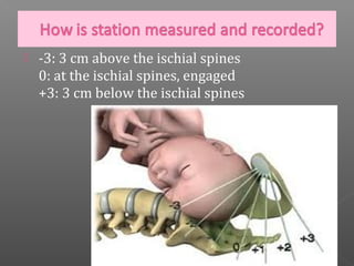    -3: 3 cm above the ischial spines
    0: at the ischial spines, engaged
    +3: 3 cm below the ischial spines
 