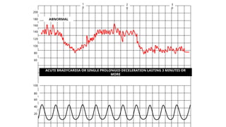 Normal and abnormal labour+ctg.pptx obst | PPTX
