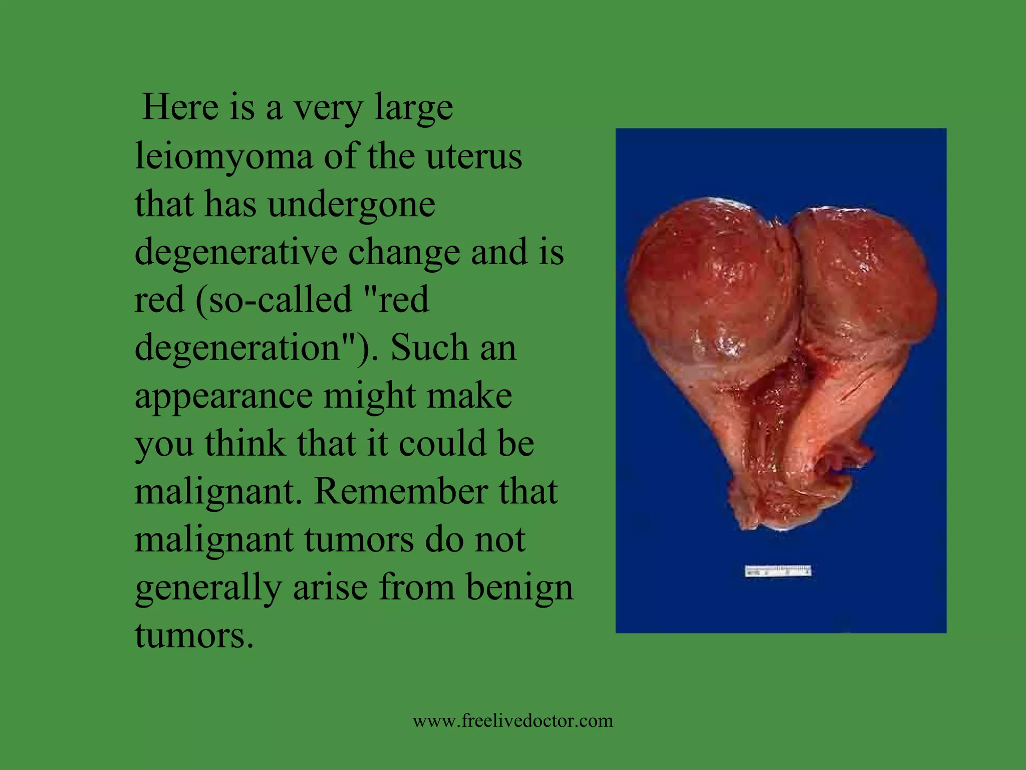 Here is a very large leiomyoma of the uterus that has undergone degenerative change and is red (so-called "red degeneration"). Such an appearance might make you think that it could be malignant. Remember that malignant tumors do not generally arise from benign tumors. www.freelivedoctor.com 